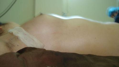 丰胸过程视频,视频解析美丽蜕变之旅